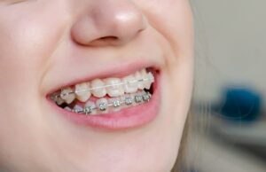 Diamond Braces: The Perfect Solution to Achieving a Stunning Smile