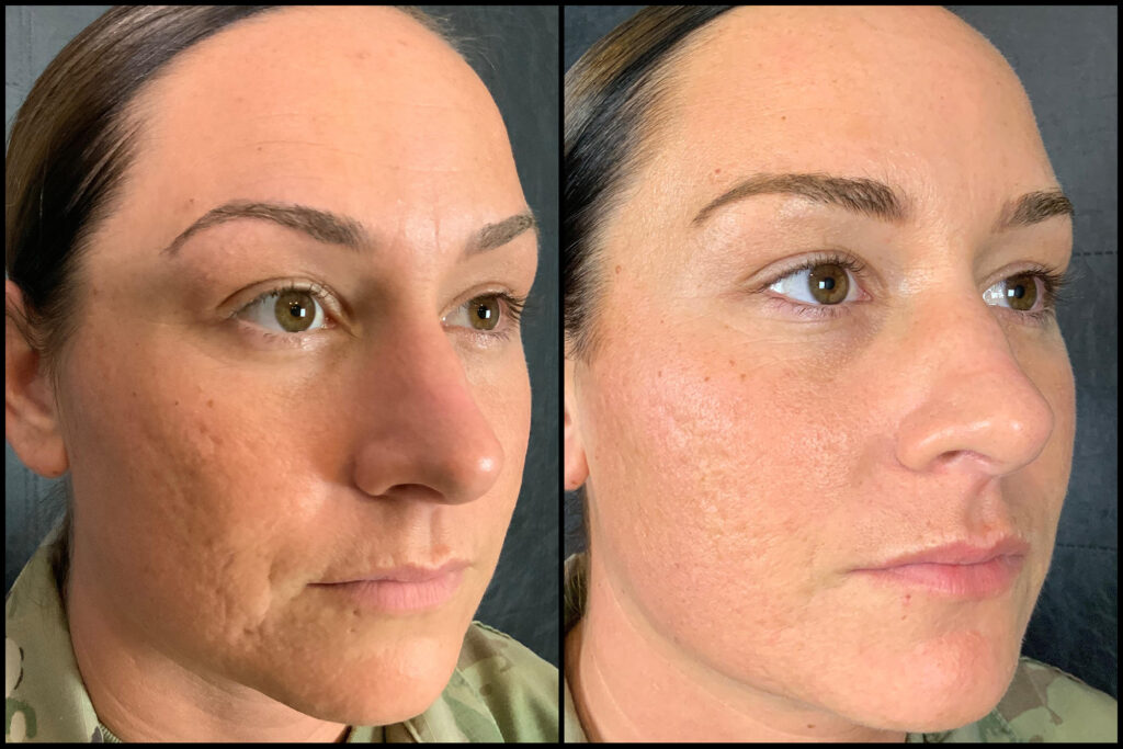 Microneedling Before and After