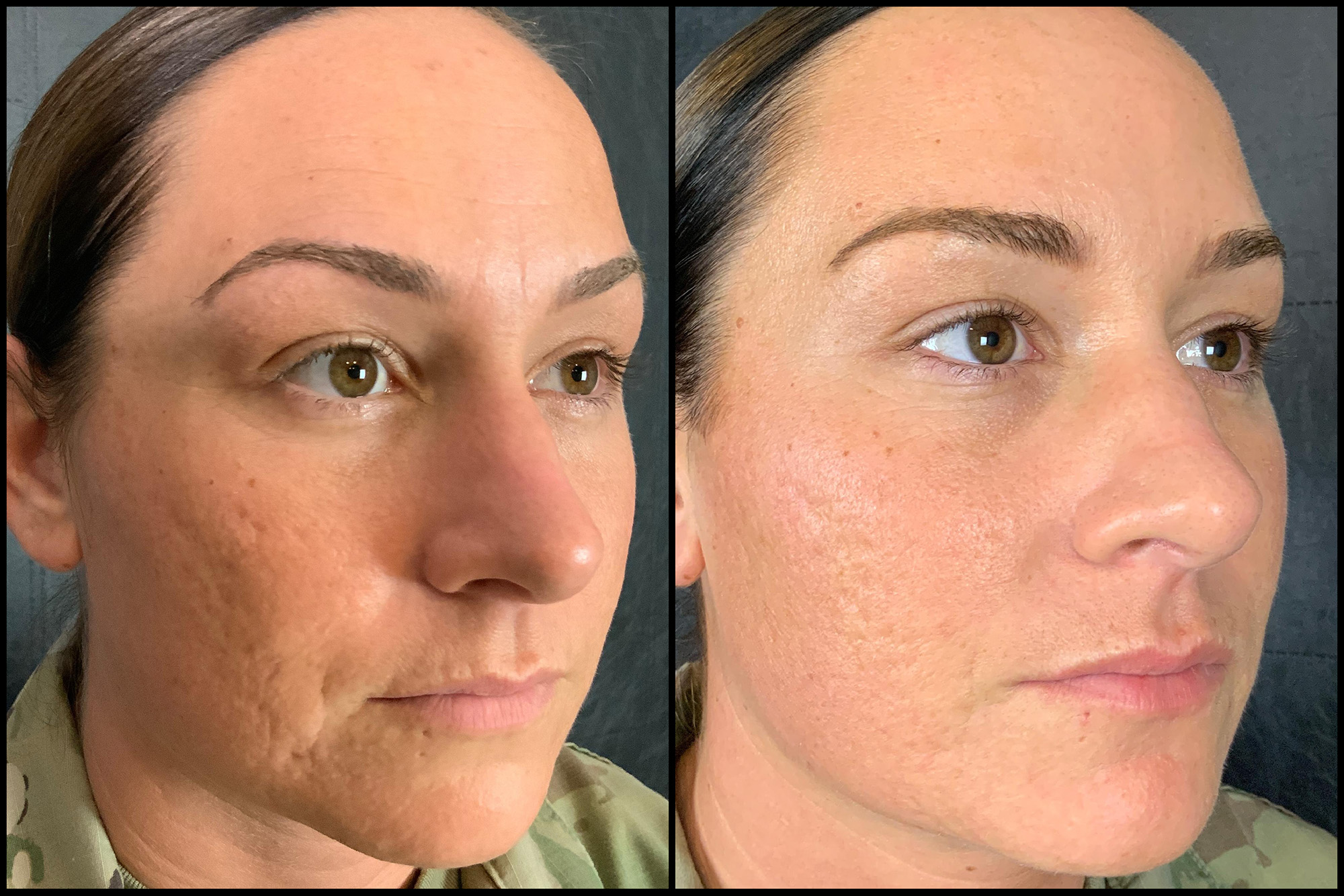 Microneedling Before And After Unlocking The Secrets To Rejuvenated 