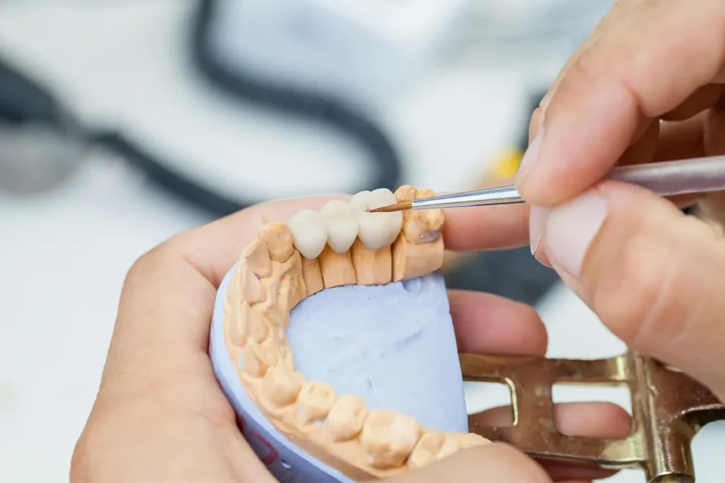 Dental Bridge vs Implant
