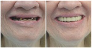 Dental Bridge vs Implant