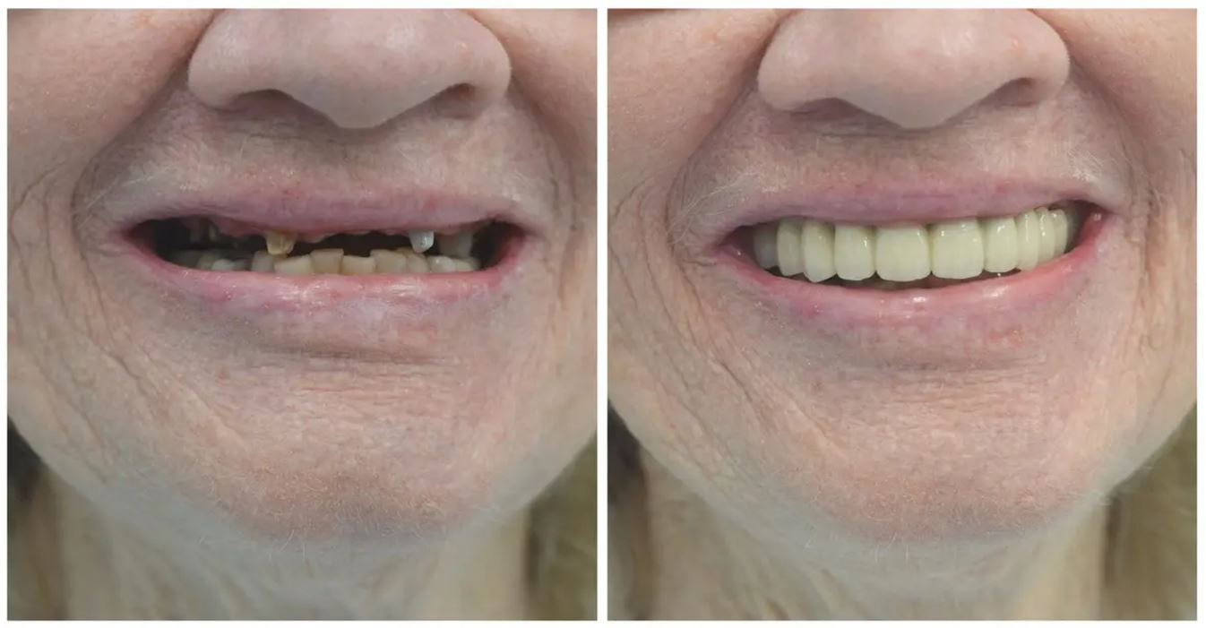 Dental Bridge vs Implant